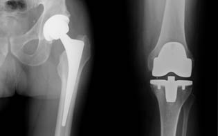 Hft- und Knie- Endoprothese